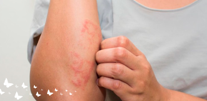 2 Psoriasis