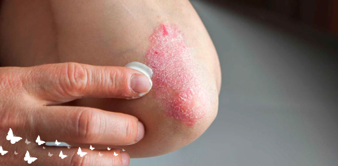 3 Psoriasis