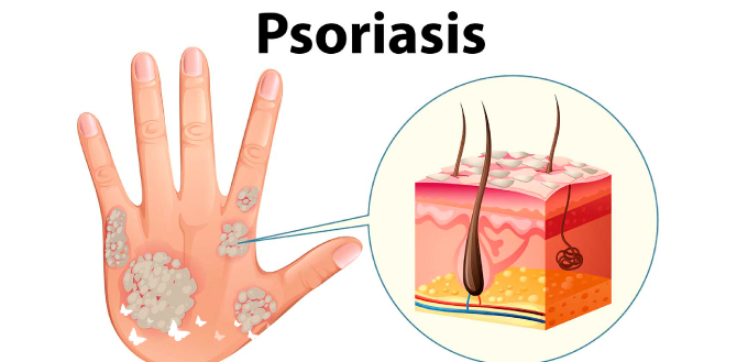4 Psoriasis